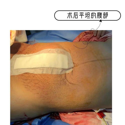 怀孕8月广东19岁女生肚里掏出6斤娃,和30多斤